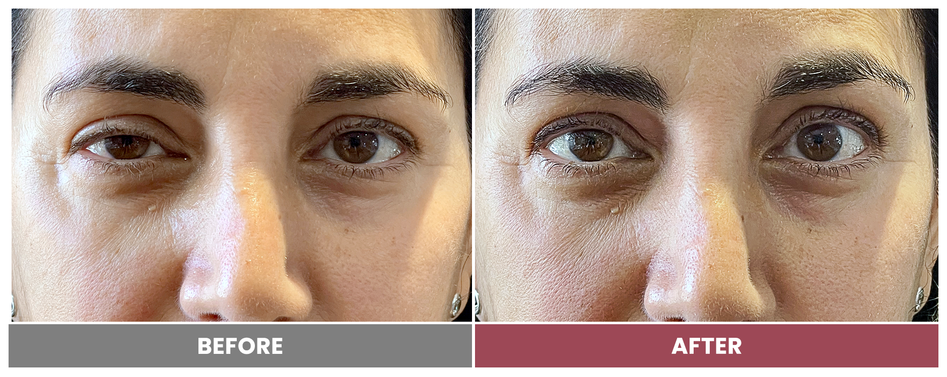 PTOSIS REPAIR - Case 62